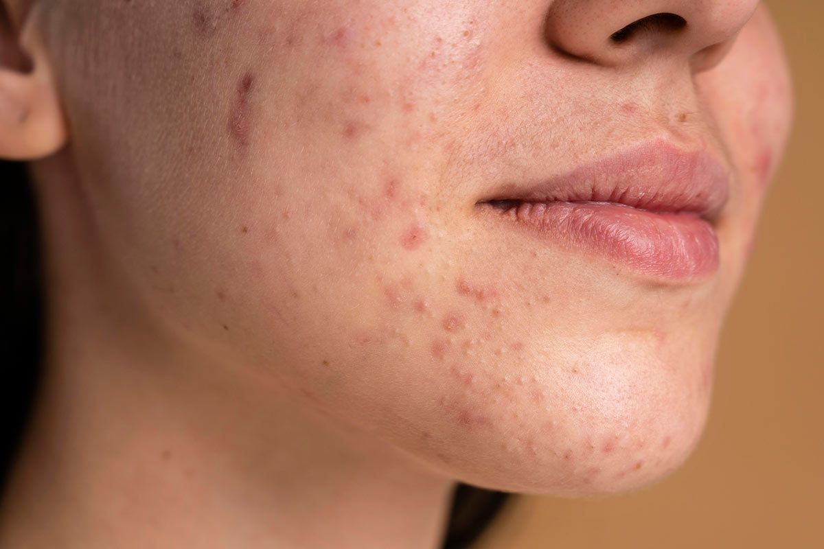 Tratamento de Acne